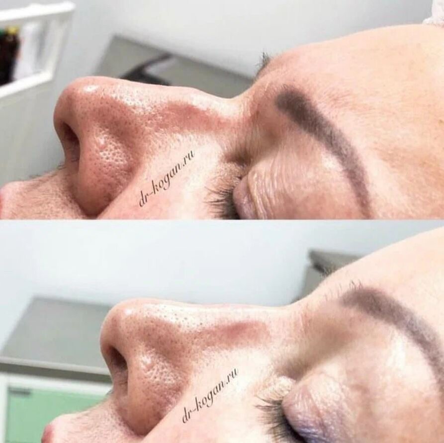 Коррекция носа филлером с использованием канюли. Фото до и после. Фото предоставлено врачом дерматологом косметологом клиники Д.Р. Гришкяна - Коган Л.С. Имеются противопоказания, требуется консультация специалиста