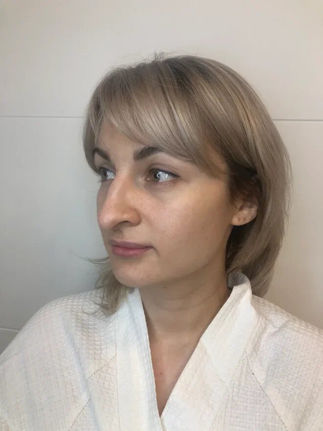 Фото до ринопластики