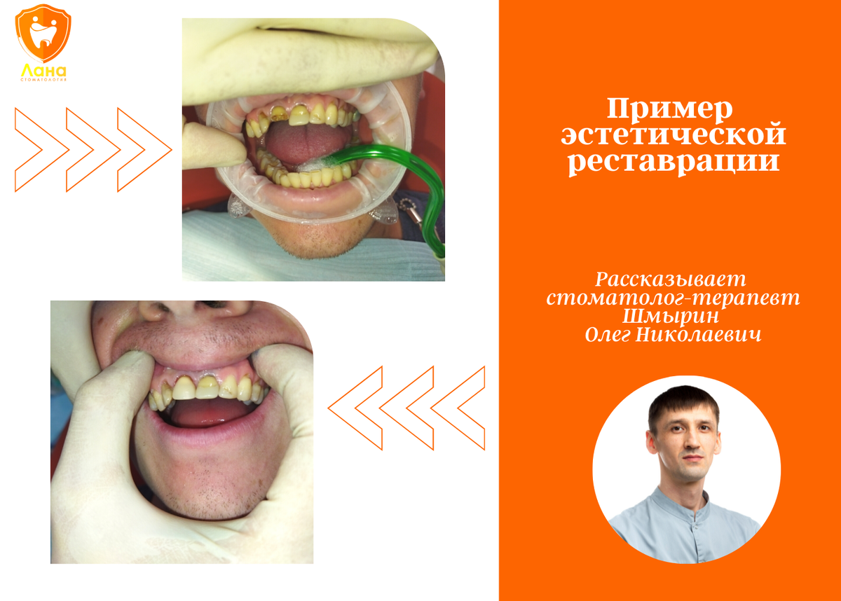 Эстетическая реставрация зуба 11