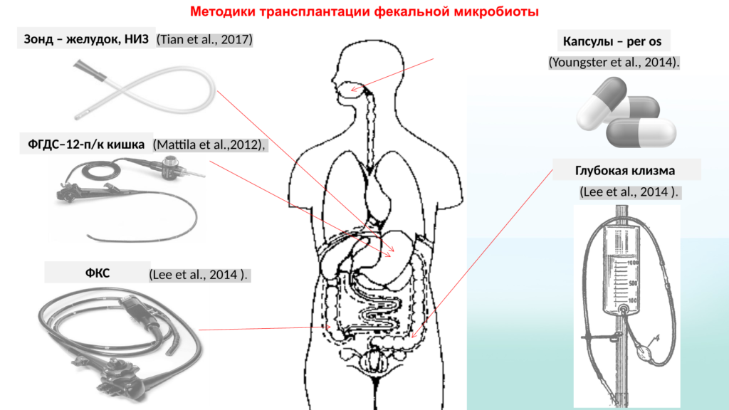 Пересадка кала что это. Трансплантация фекалий. Трансплантация кала группа. Трансплантация кала Мем. Бикавальная методика пересадки сердца.