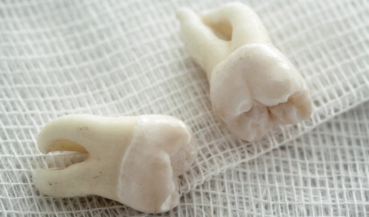 Рекомендации после удаления зуба - ГАУЗ Республиканская стоматологическая поликлиника