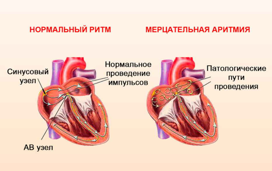 Синусовая брадикардия сердца