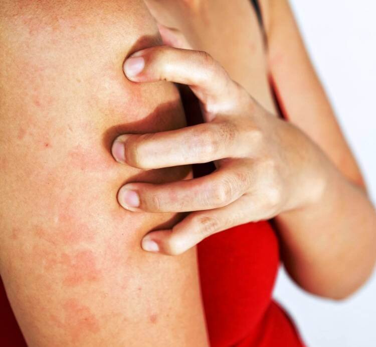 красные пятна-ожоги от воды