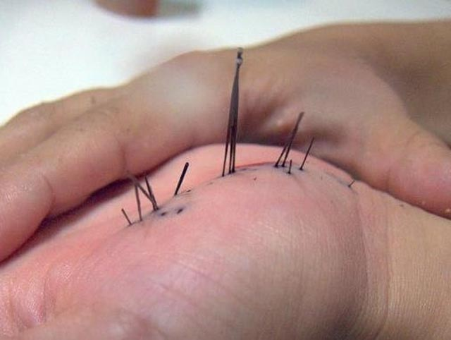 Иглы морского ежа в руке. К счастью, не в моей.)) Фото с сайта https://www.jurnaliska.com/