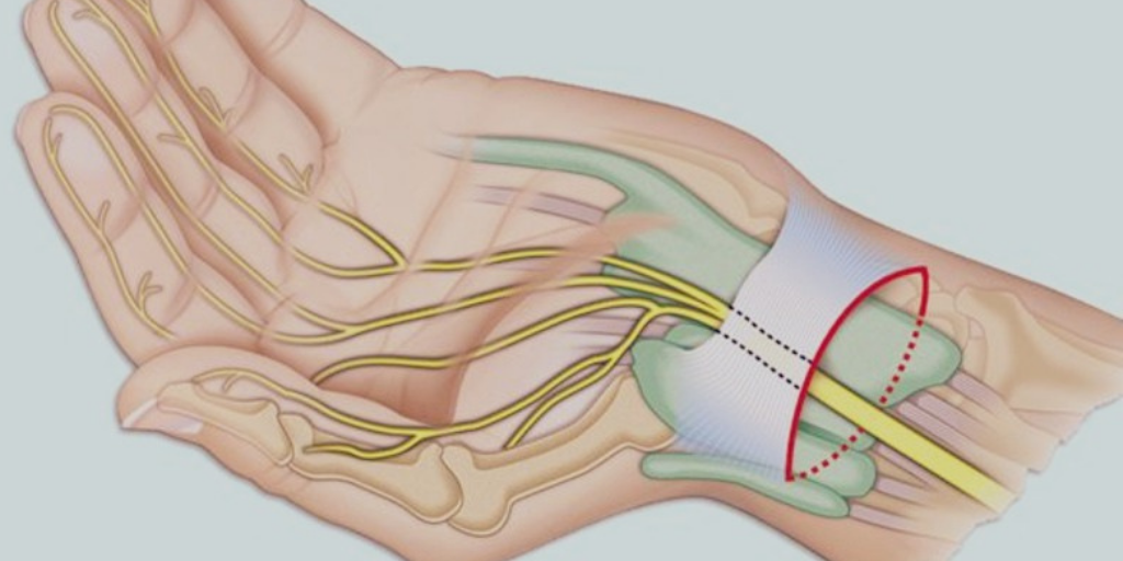 Туннельный синдром фото