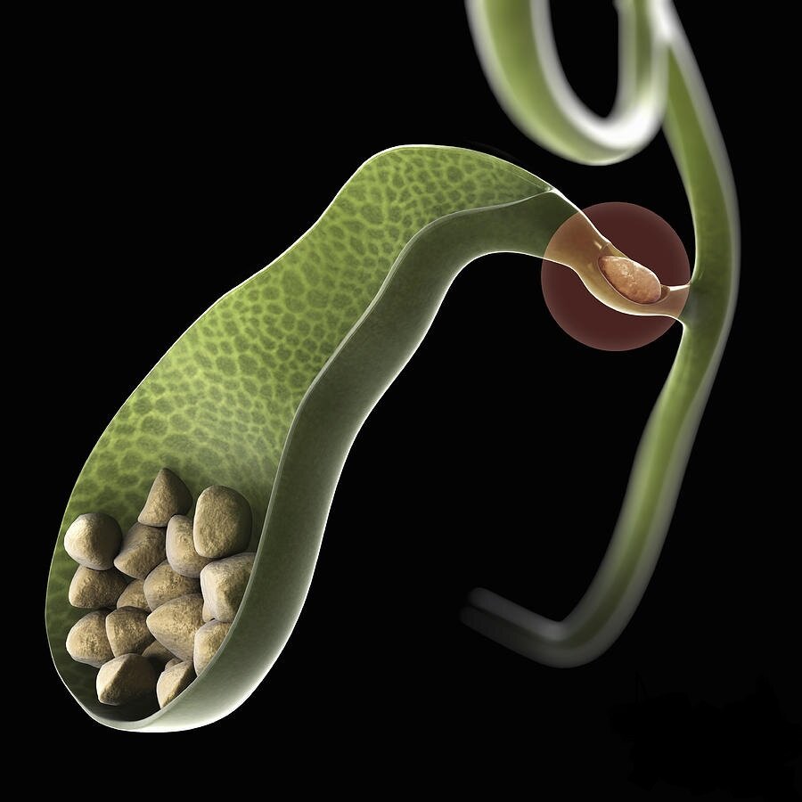 Камни в желчном пузыре, один из них заплыл в желчный проток, тут уже потребуется не только убирать желчный, но и доставать камнь из протока. При этом будут резкие боли в правом подреберье, резкое пожелтение кожных покровов и, вероятнее всего, поднимется температура тела. Ссылка на источник изображения: https://clck.ru/32TbcC