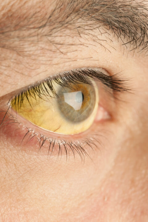 Птеригиум - глазное заболевание, возникающее при влиянии солнца