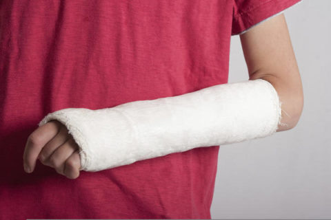 При переломах предплечья чаще всего используют гипсовую повязку.