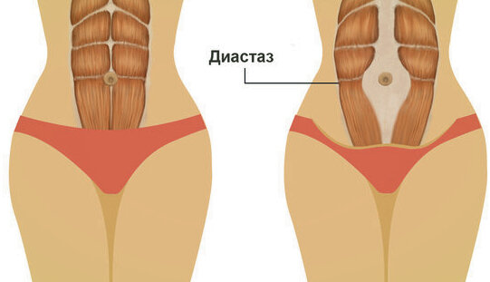 Так схематично выглядит диастаз