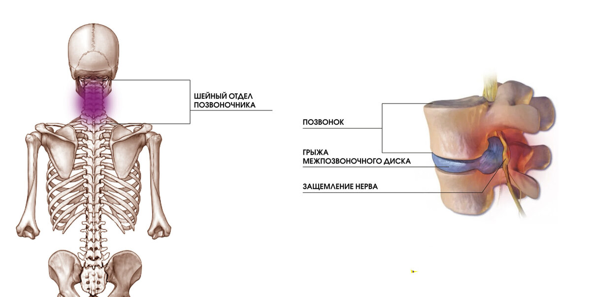Защемление поясничного нерва. Защемление нерва в грудном отделе позвоночника симптомы. Защемление шейного нерва. Радикулопатия пояснично-крестцового. Зажало нерв в грудном отделе.