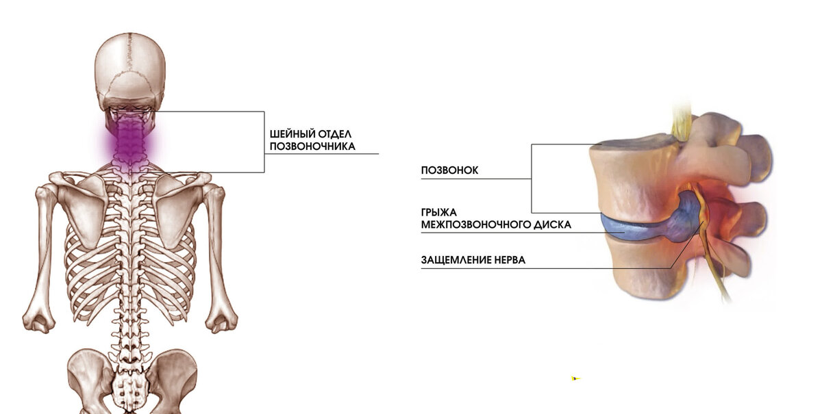 Удаление грыжи шейного отдела позвоночника отзывы