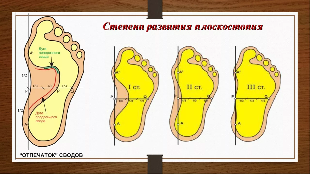 Появилась боль под коленом. Что это может быть? | Сам Себе Ортопед. Спб. |  Дзен