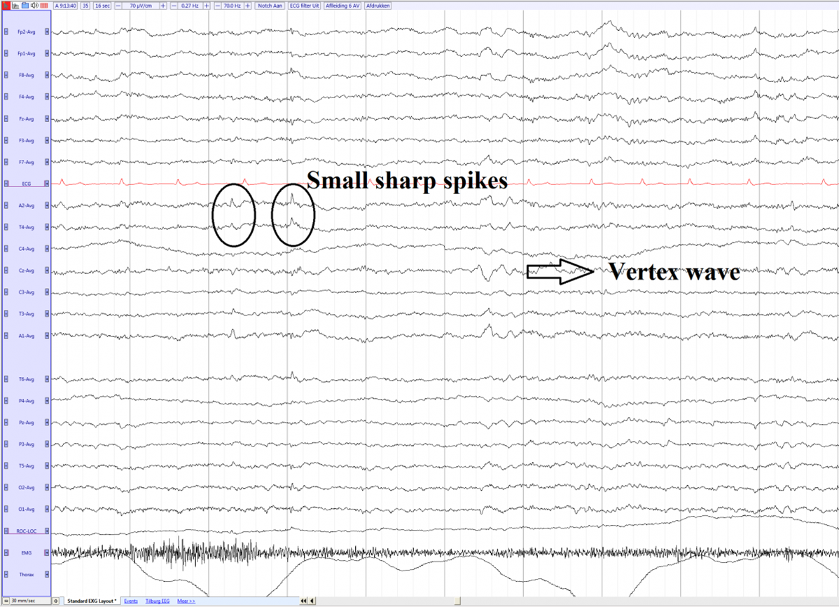 Лямбда волны на ЭЭГ. Small Sharp Spikes EEG. Спайк волна на ЭЭГ. Спайк на ээг
