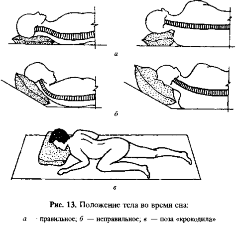  Схематическое изображение расположения тела на сон в норме и патологии.