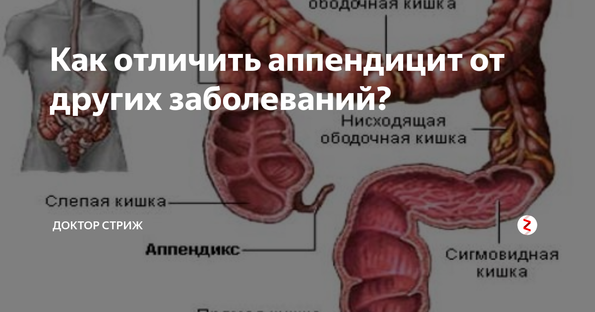 Аппендицит симптомы как узнать. Как определить аппендицит. Аппендицит симптомы с какой стороны. Где находится аппендицит у мужчин с какой стороны. Как понять что у меня аппендицит.