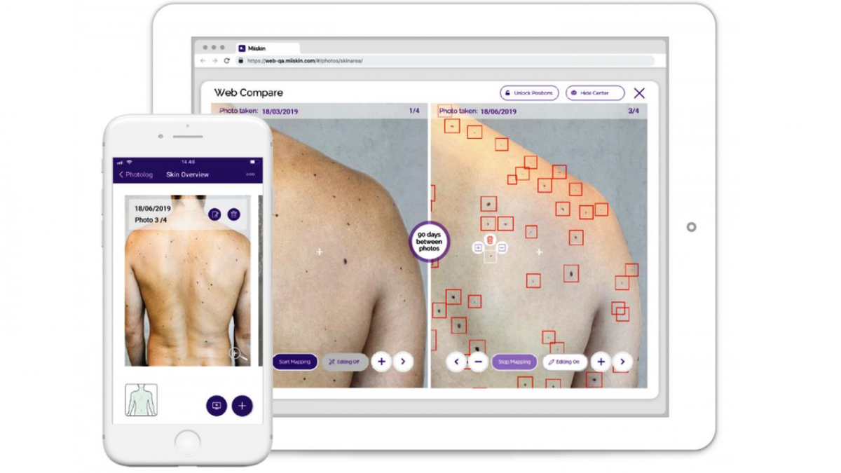 Miiskin использует AI для обнаружения признаков меланомы 
