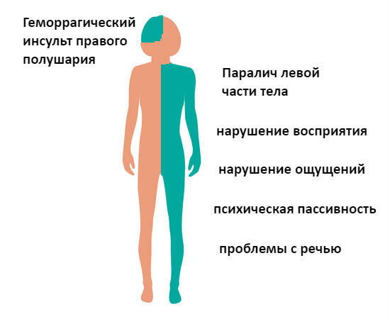 Реабилитация и восстановление после инсульта в домашних условиях и стационаре