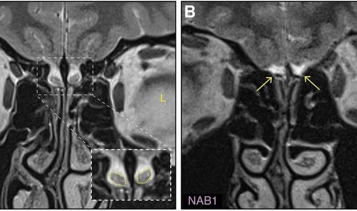 Слева — МРТ нормального мозга; справа — МРТ мозга девушки без обонятельных луковиц / © Weiss et al., Neuron, 2019 