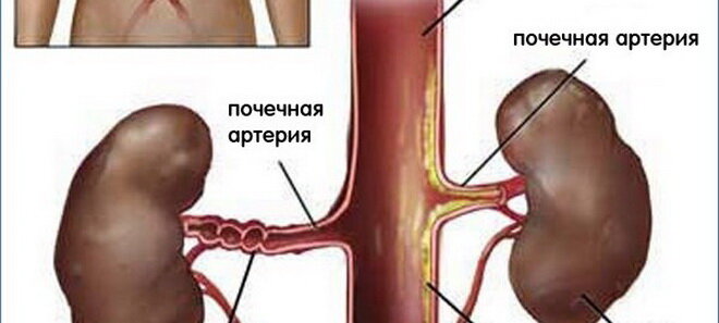 Солитарная почечная артерия. Добавочная почечная артерия. Аберрантная артерия почки. Фибромускулярная дисплазия почечной артерии. Стеноз почечной артерии ангиография.