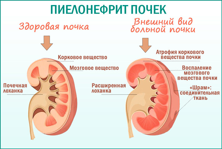 трансформация здорового органа  в разрушающиеся 