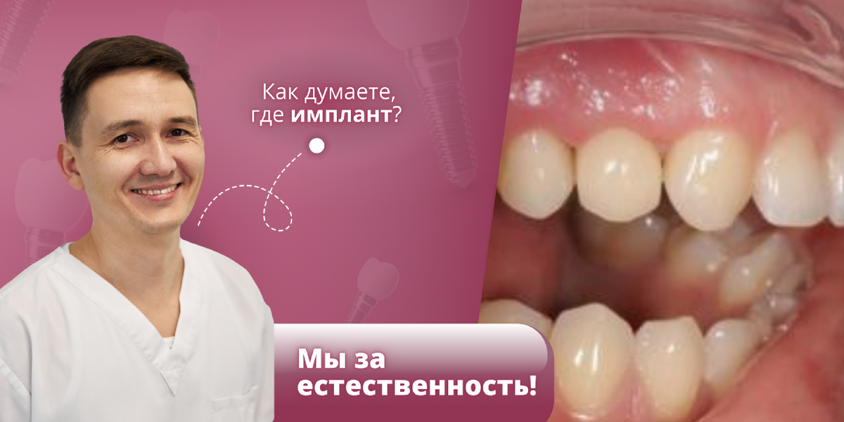 зубной имплант