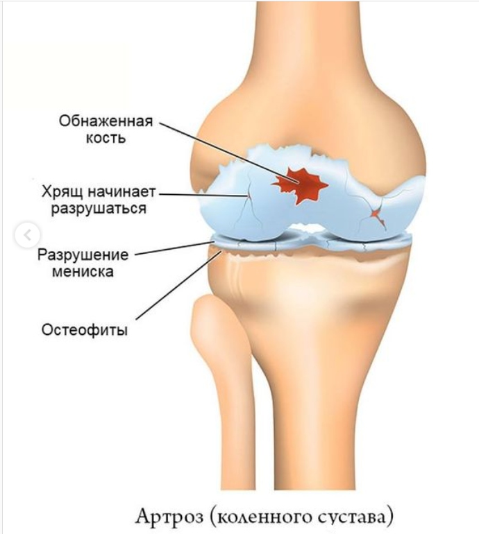 Головка кости