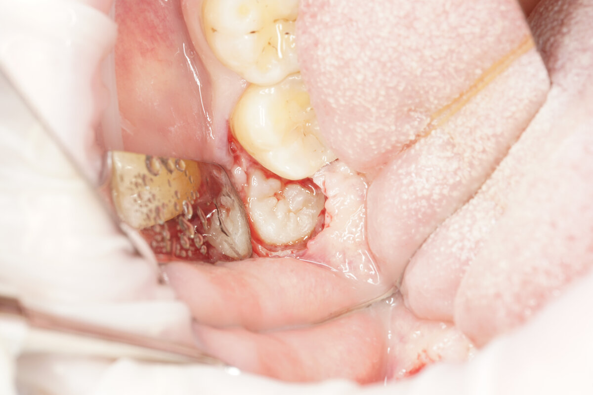 Открыт доступ к зубу мудрости