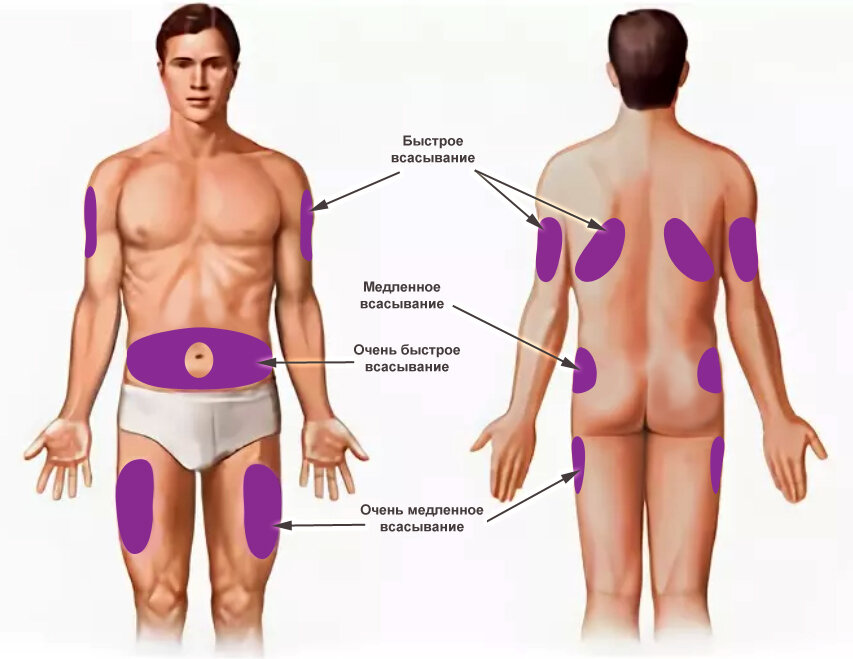 Укол в домашних условиях: как поставить, виды, в какое место, как делать самостоятельно
