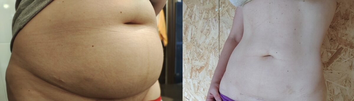 Ушло более 30 см в объеме менее чем за год. Осталось каких-то 5 см и поработать с кожей. Все это без операций, без спортзала, за 15 минут в день.