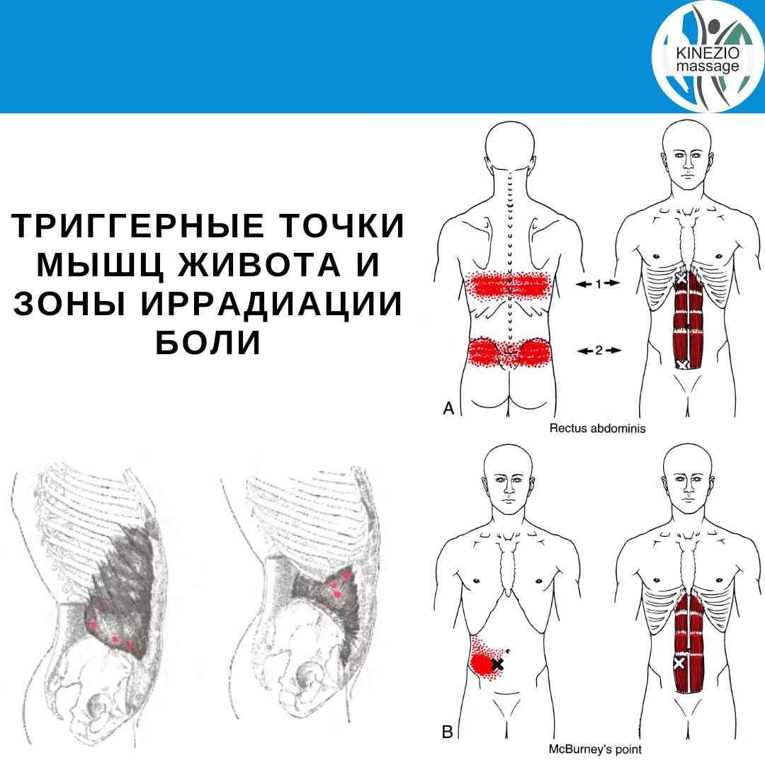 Помоги себе сам. Диастаз. | Студия красоты и здоровья | Дзен