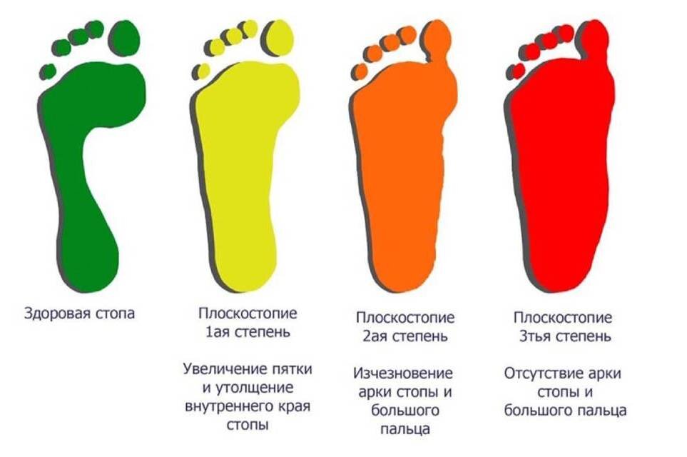 Комплекс физических упражнений при лечении плоскостопия