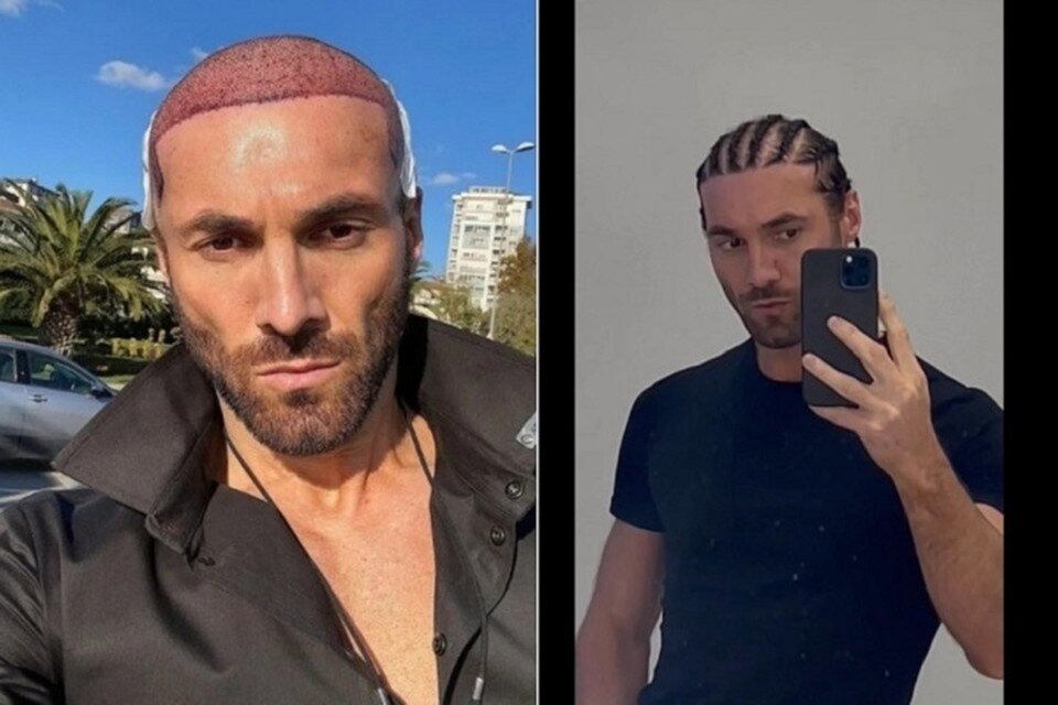     Процесс приживления волосяных луковиц на голове оказался очень небыстрым. Фото сделано год назад (слева) и сейчас.