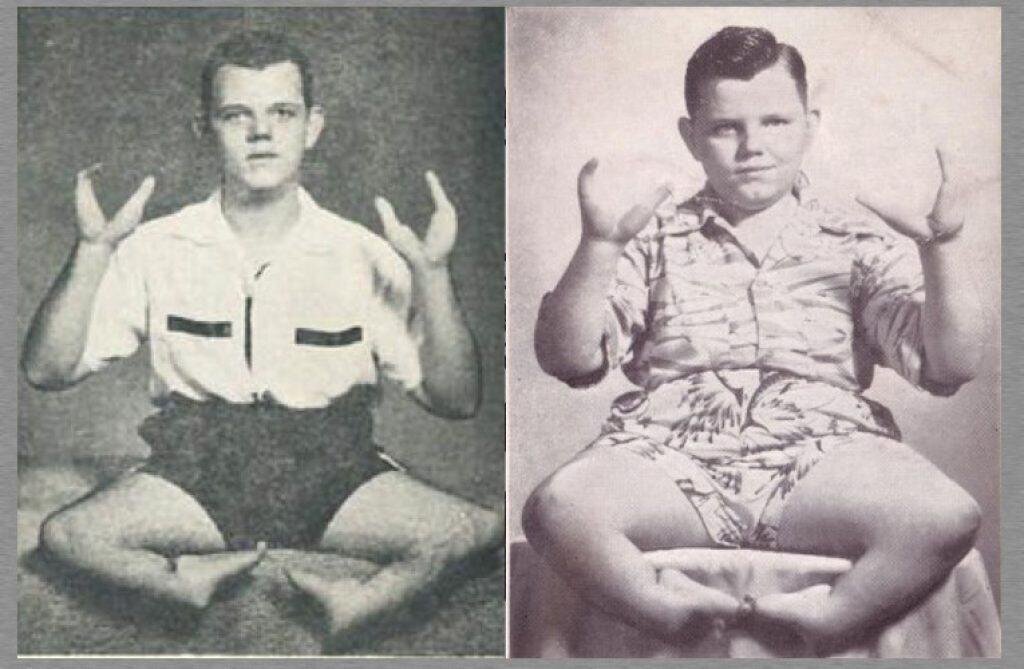 Мальчик-лобстер Грейди Стайлз.