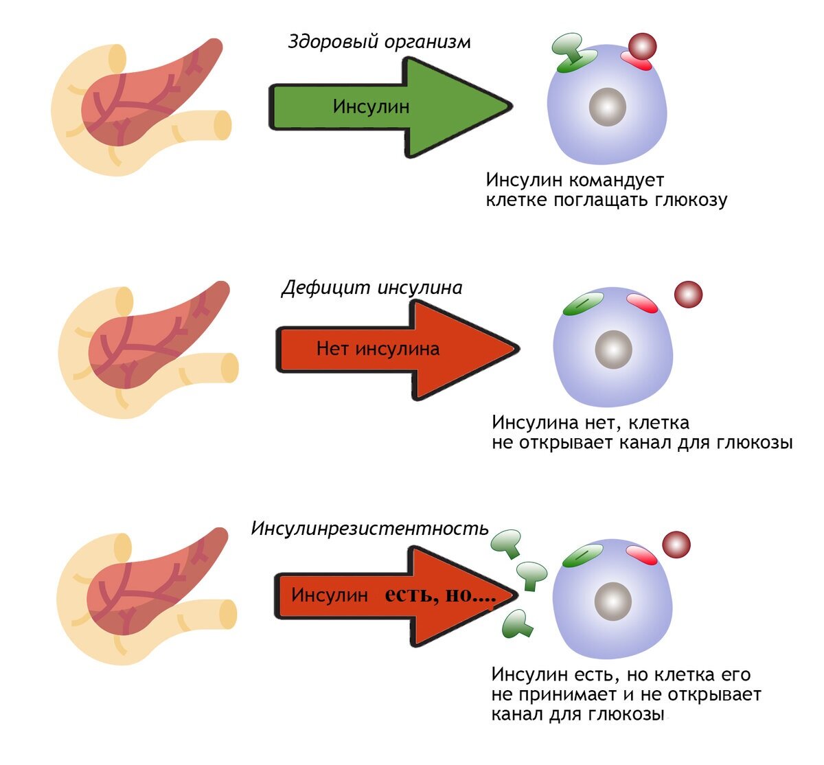 Сахарный диабет железы. Как работает инсулин в организме человека. Сахарный диабет инсулин. Сахарный диабет поджелудочная железа. Поджелудочная железа вырабатывает инсулин который.