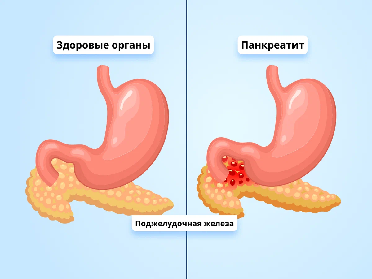 куда отдает боль при панкреатите фото