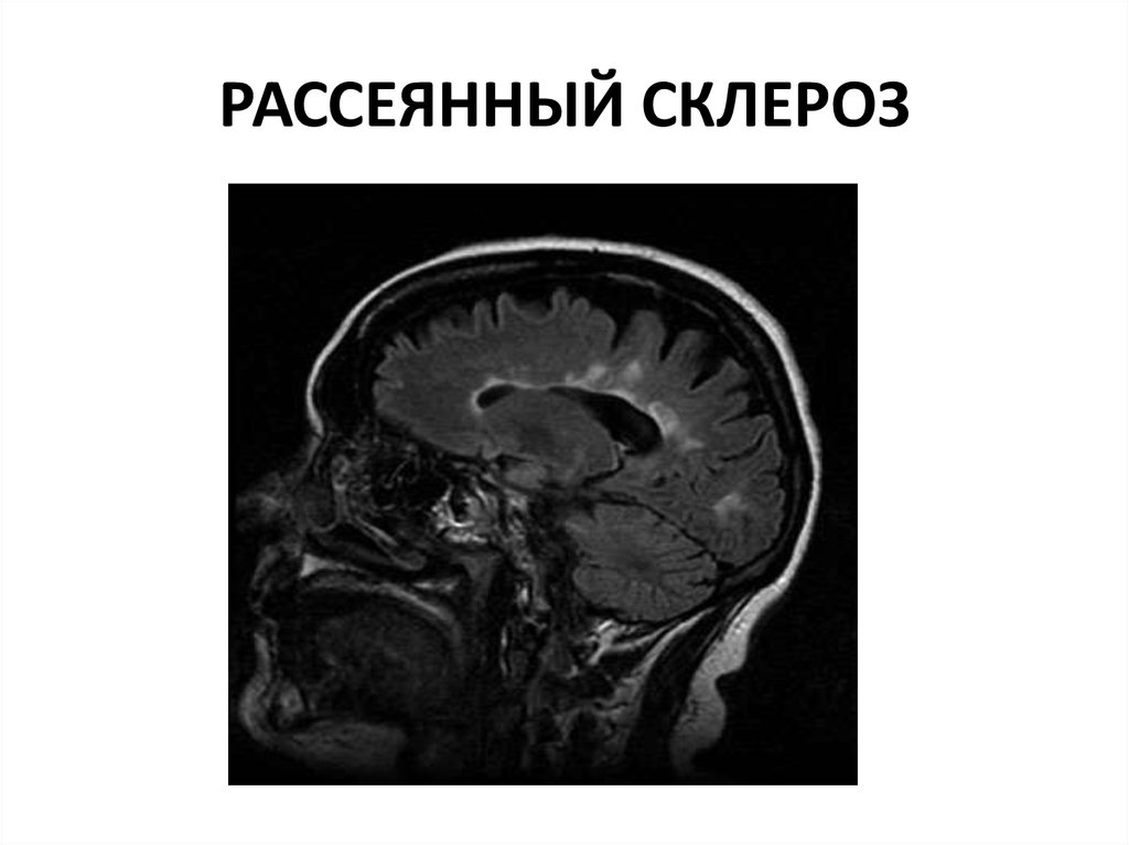 Признаки и диагностика рассеянного склероза. Рассеянный склероз офтальмологические симптомы. Клинические проявления рассеянного склероза. Картинки рассеянного склероза. Ранние стадии склероза.