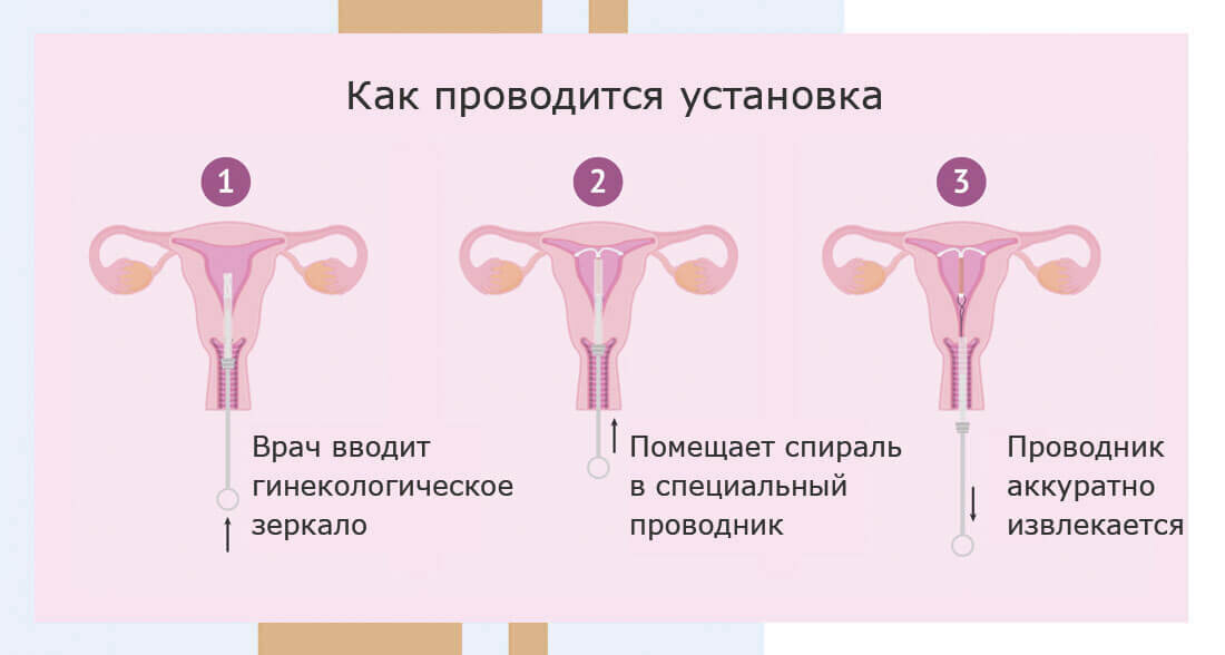вмс внутриматочная спираль. маточная спираль внутри. вмс внутриматочная спираль. внутриматочная контрацепция (вмк). спираль внутриматочная мирена в матке.