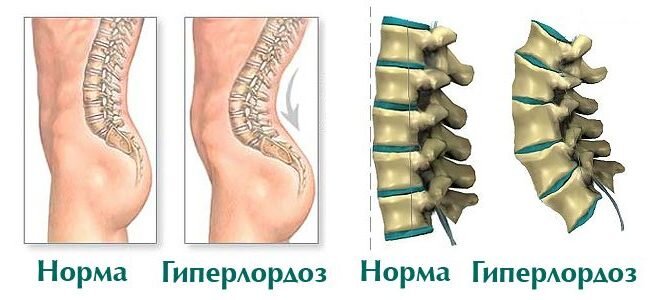 Чтобы разобраться, опасен ли гиперлордоз поясничного отдела позвоночного столба, необходимо вспомнить анатомию. В теле заложено в норме 2 изгиба.