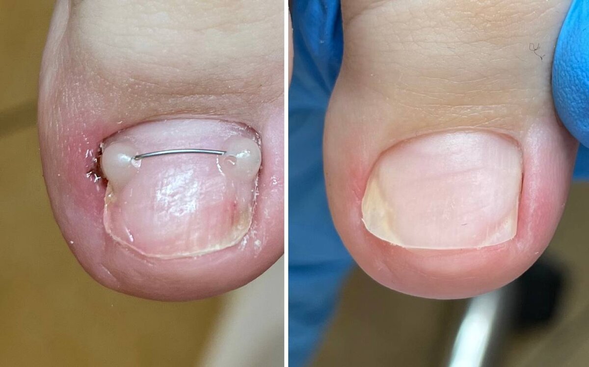 Когда для тампонады уже поздно ставят титановую нить.