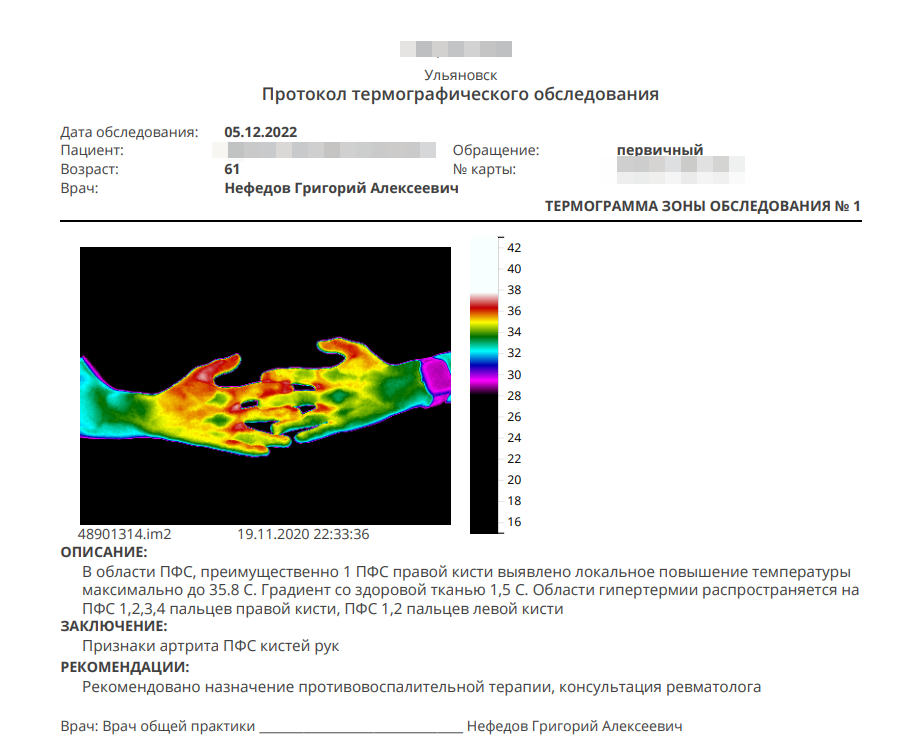 Кисти пациента при первичном обращении с ярко выраженными явлениями артрита суставов кистей рук. В дальнейшем у пациента подтвердился диагноз ревматоидного артрита. Укладка кистей здесь немного не правильная, на тот момент мы только учились обращаться с оборудованием, допускали ошибки 😉 В карусели результаты того же пациента после назначения лечения —>
