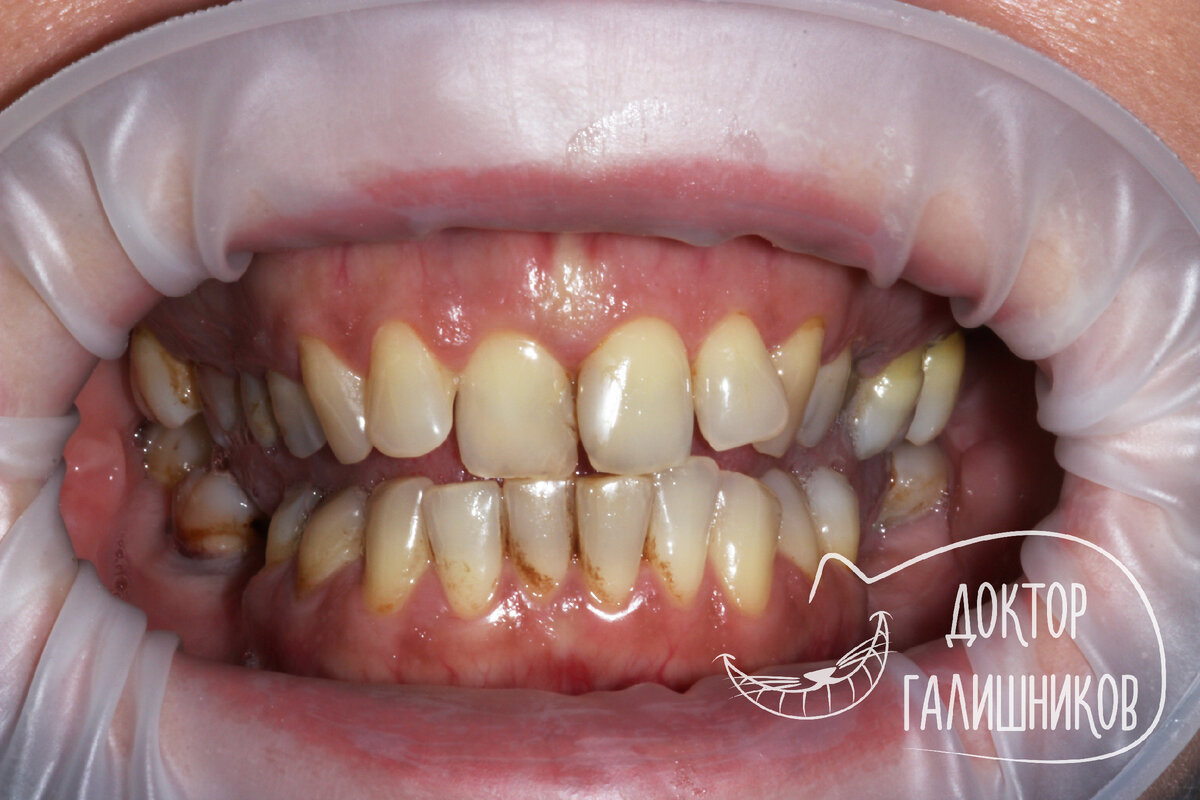 Я не хочу ставить брекеты, выровняйте мне зубы винирами! | Галишников ...
