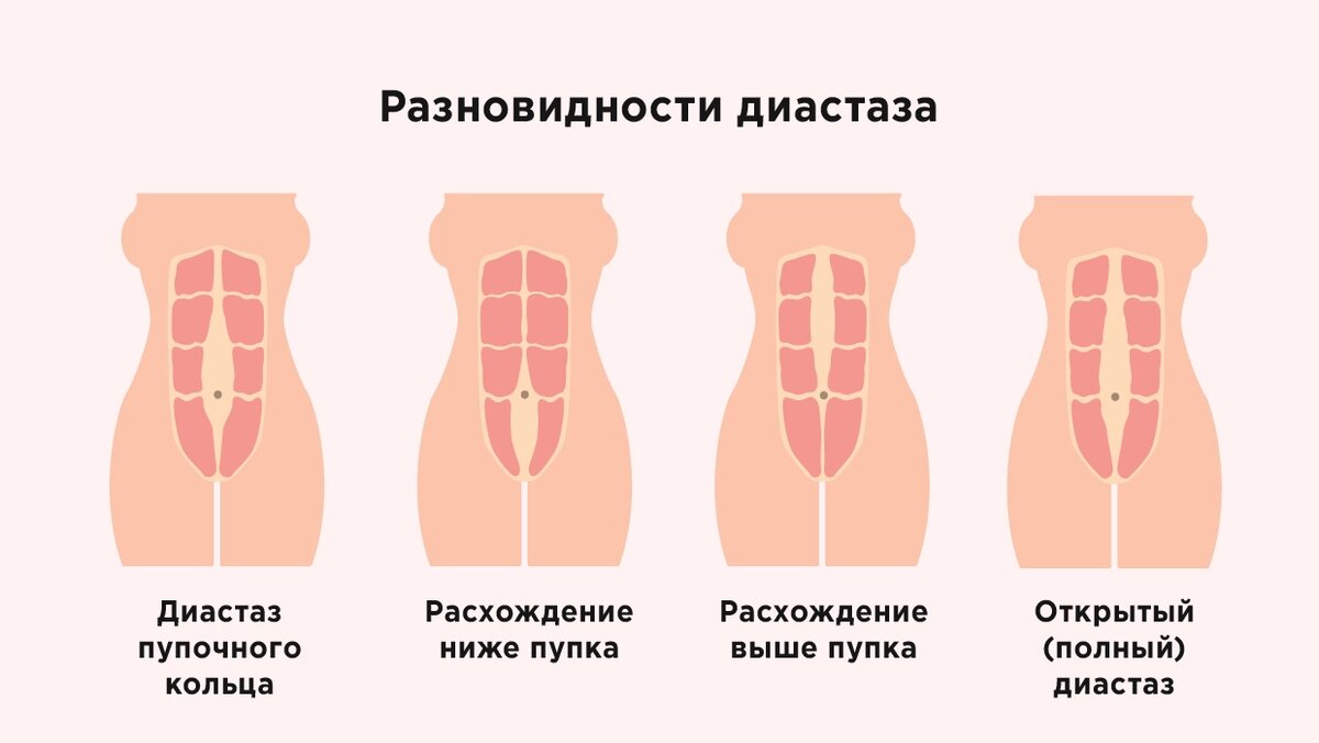 Диастаз это простыми словами у женщин