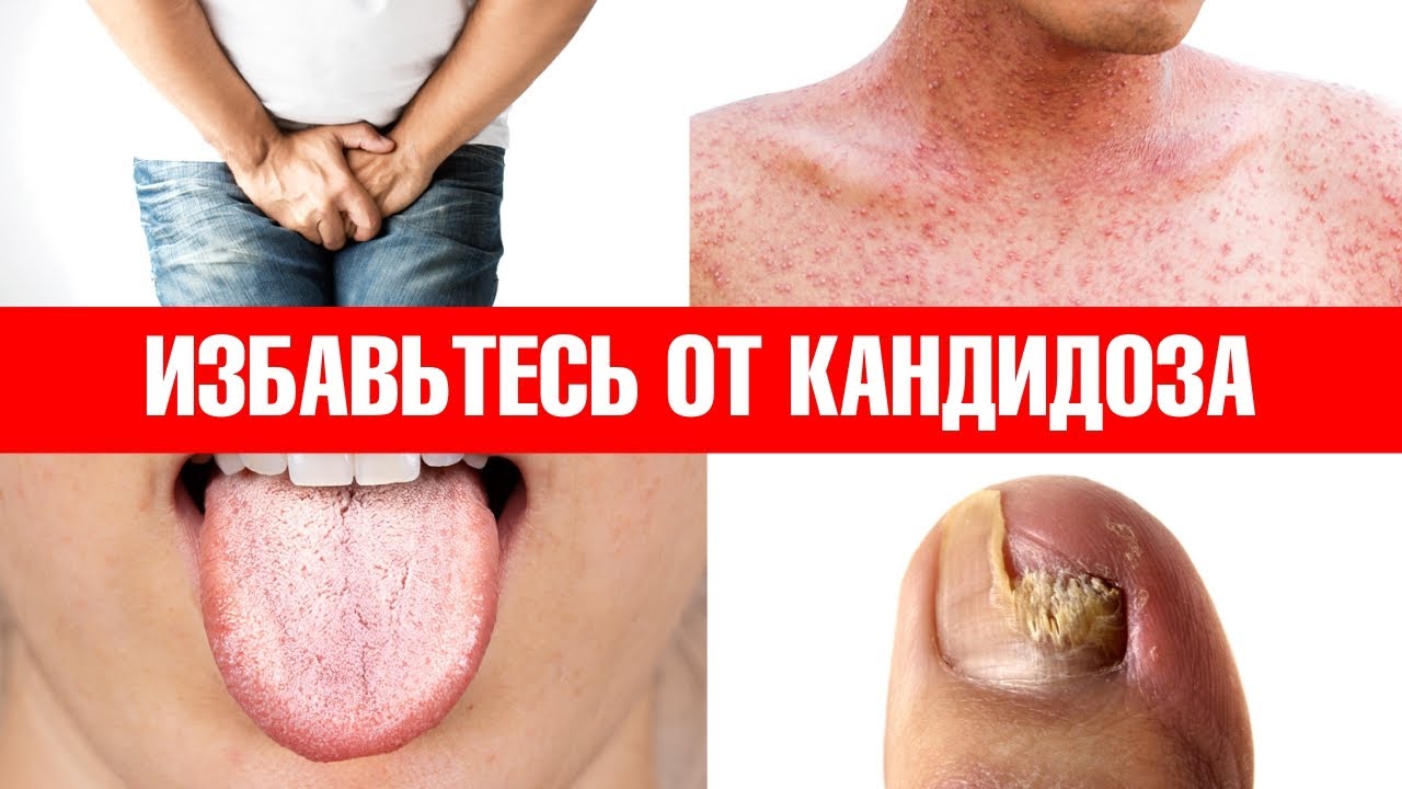 Лечение кандидоза: симптомы, диагностика, лечение Киев