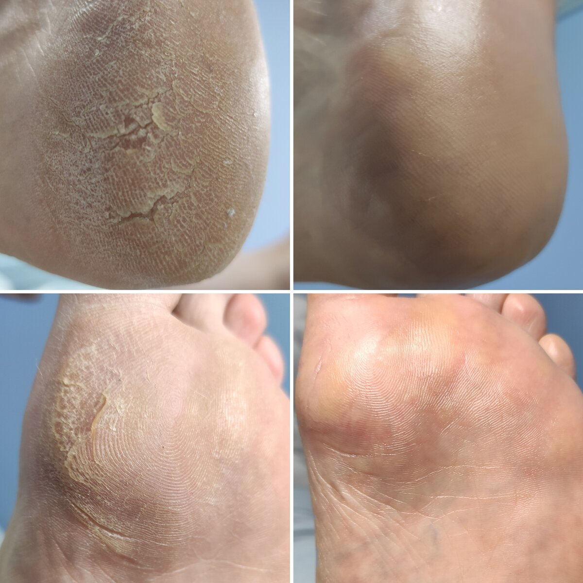 Обработка стоп с трещинами 