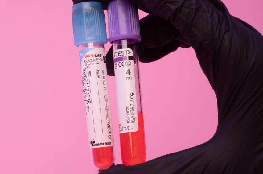     Зачем сдавать анализ на билирубин? Какая норма и как подготовиться?