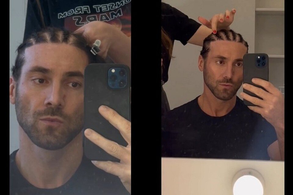     Процесс заплетания пересаженных волос. Скрин видео