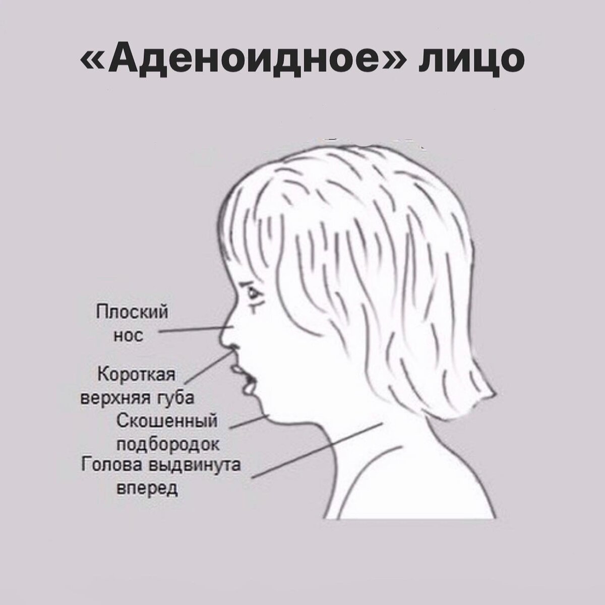 Аденоидное лицо: что это и почему это повод обратиться к врачу