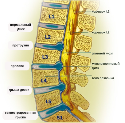 Степени грыжи