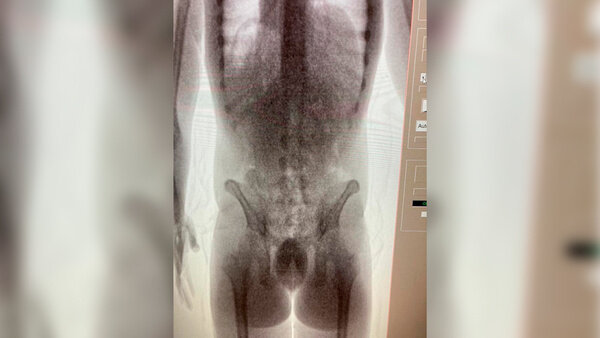 Снимки мужчины, который пытался пронести кокаин в желудке. Фото © Telegram / ФТС России | ProТаможню