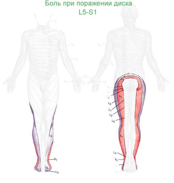 Позвоночник диск l5 s1 схема